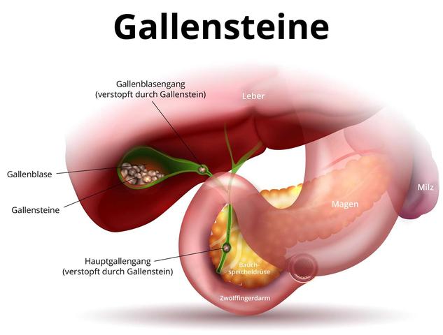 Gallenkolik: Ursachen und effektive Behandlungsmethoden Gallenkolik: Ursachen und effektive Behandlungsmethoden