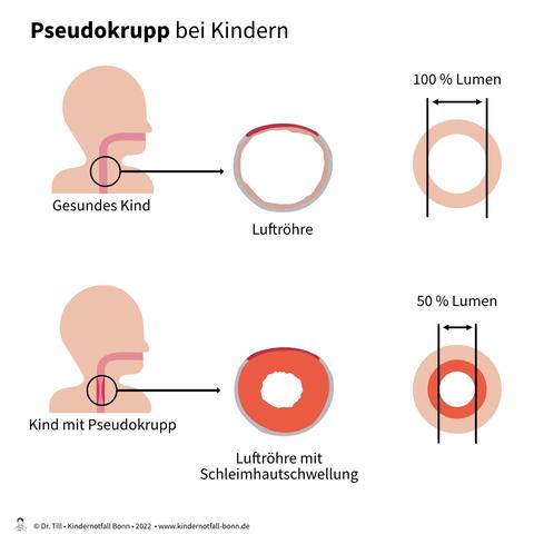 Pseudokrupp-Anfall bei Kindern: Was Eltern tun können Pseudokrupp-Anfall bei Kindern: Was Eltern tun können