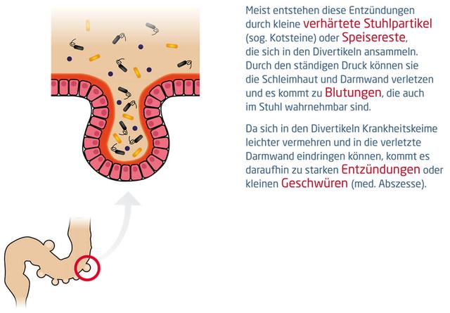 Praktische Empfehlungen zur Behandlung von Divertikulitis Praktische Empfehlungen zur Behandlung von Divertikulitis