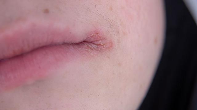 Wie man eingerissene Mundwinkel behandelt: Effektive Hausmittel und Pflegetipps