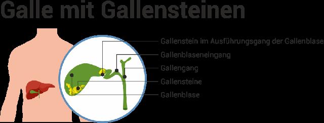 Was tun bei Gallenschmerzen? Praktische Lösungen für Beschwerden Was tun bei Gallenschmerzen? Praktische Lösungen für Beschwerden