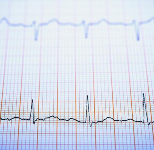 Effektive Strategien zur Bewältigung von Herzrhythmusstörungen