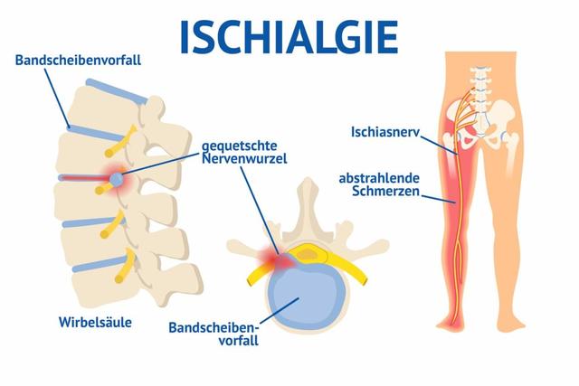 Rückenschule und Bewegungstherapie als langfristige Lösungen bei Ischiasschmerzen Rückenschule und Bewegungstherapie als langfristige Lösungen bei Ischiasschmerzen