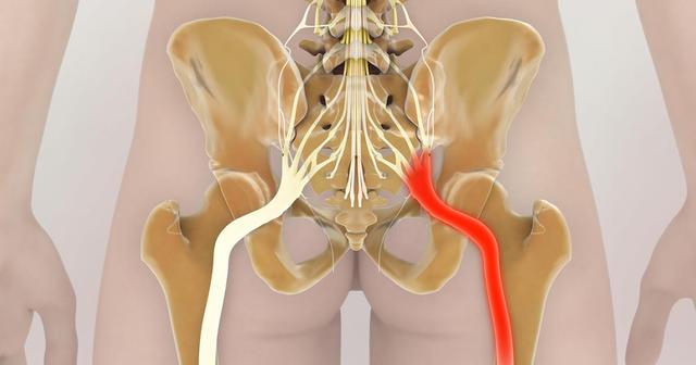 Wann ist eine Operation bei Ischiasschmerzen notwendig? Wann ist eine Operation bei Ischiasschmerzen notwendig?