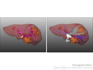 Lebermetastasen: Was passiert, wenn die Leber voller Metastasen ist? Lebermetastasen: Was passiert, wenn die Leber voller Metastasen ist?