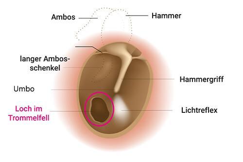 Tipps zur Behandlung eines Lochs im Trommelfell Tipps zur Behandlung eines Lochs im Trommelfell