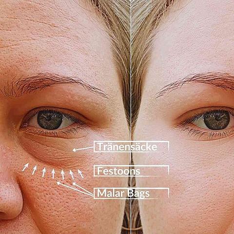 Malar Bags reduzieren: Effektive Maßnahmen zur Selbstbehandlung