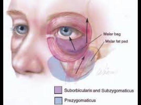 Malar Bags selbst behandeln: Tipps und Methoden zur Eigenbehandlung