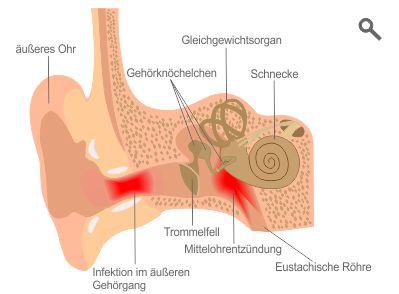 Tipps zur Linderung von Mittelohrentzündungen: Was kann helfen? Tipps zur Linderung von Mittelohrentzündungen: Was kann helfen?
