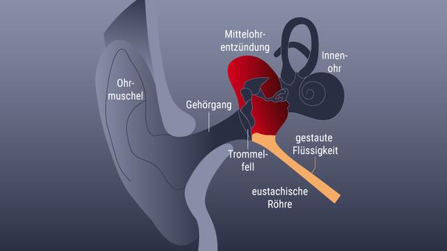Empfehlungen vom HNO-Arzt: Wie Sie eine Mittelohrentzündung behandeln können Empfehlungen vom HNO-Arzt: Wie Sie eine Mittelohrentzündung behandeln können