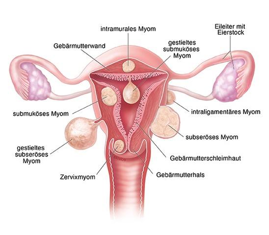 Myom in der Gebärmutter: Symptome, Diagnose und Therapieoptionen Myom in der Gebärmutter: Symptome, Diagnose und Therapieoptionen