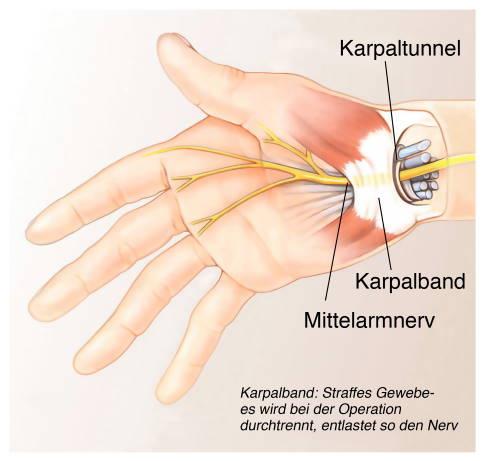 Karpaltunnelsyndrom vorbeugen und behandeln: Tipps und Strategien für Betroffene Karpaltunnelsyndrom vorbeugen und behandeln: Tipps und Strategien für Betroffene