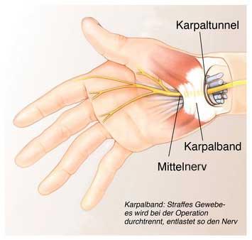 Wann ist eine Operation beim Karpaltunnelsyndrom sinnvoll? Behandlungsmöglichkeiten im fortgeschrittenen Stadium Wann ist eine Operation beim Karpaltunnelsyndrom sinnvoll? Behandlungsmöglichkeiten im fortgeschrittenen Stadium