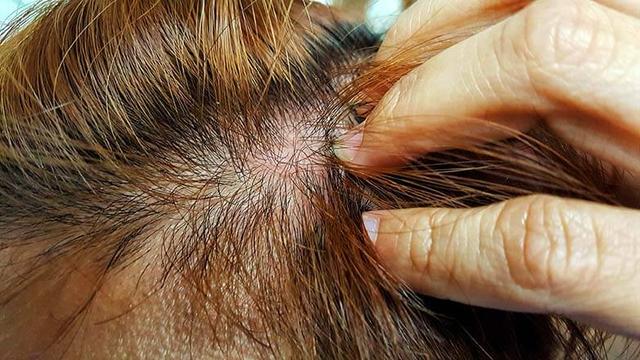 Was tun bei kribbelnder Kopfhaut? Tipps für die richtige Haarpflege Was tun bei kribbelnder Kopfhaut? Tipps für die richtige Haarpflege