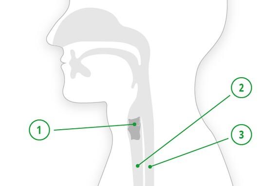 Wie man eine Kehlkopfentzündung effektiv behandelt Wie man eine Kehlkopfentzündung effektiv behandelt