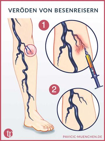 Ist es möglich, dass Besenreiser sich von selbst auflösen? Ist es möglich, dass Besenreiser sich von selbst auflösen?