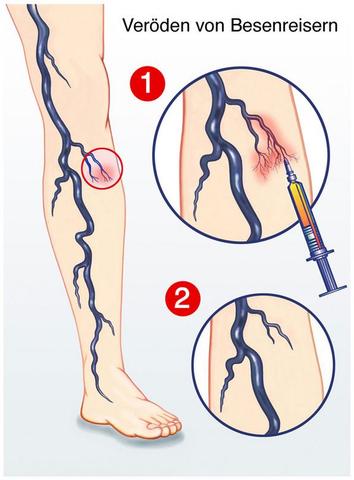 Natürliche Methoden zur Behandlung von Besenreisern ohne ärztliche Eingriffe Natürliche Methoden zur Behandlung von Besenreisern ohne ärztliche Eingriffe