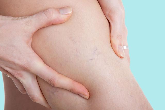 Wie kann man Besenreiser auf natürliche Weise loswerden? Wie kann man Besenreiser auf natürliche Weise loswerden?