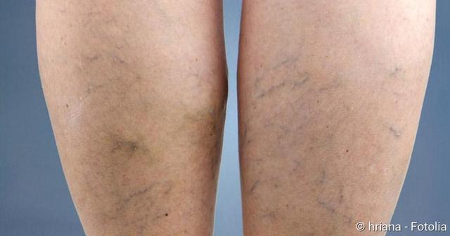 Kann man Besenreisern vorbeugen, damit sie von selbst verschwinden? Kann man Besenreisern vorbeugen, damit sie von selbst verschwinden?