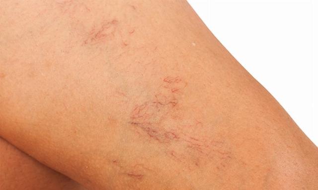 Können Besenreiser von selbst verschwinden? Können Besenreiser von selbst verschwinden?