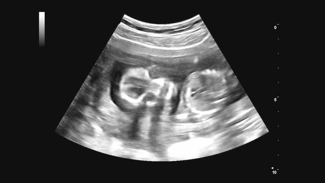 Schwangerschaftsabbruch: Bis zu welchem Zeitpunkt ist er möglich?