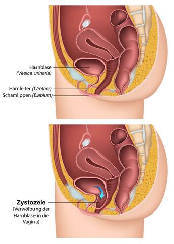 Wie man eine Blasensenkung selbst ertasten kann: Anleitung und Tipps