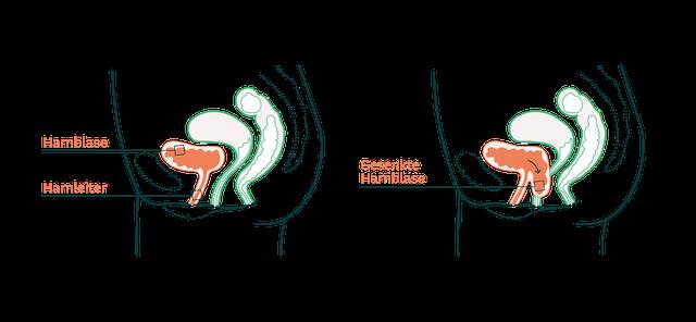 Selbstuntersuchung bei Blasensenkung: Wie Sie die Symptome erkennen