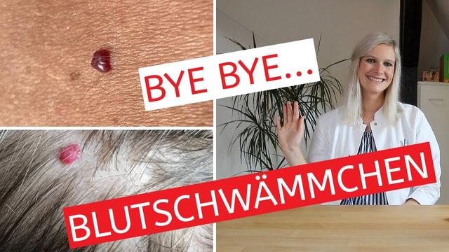 Natürliche Hausmittel zur Entfernung von Blutschwämmchen: Erfahren Sie mehr Natürliche Hausmittel zur Entfernung von Blutschwämmchen: Erfahren Sie mehr