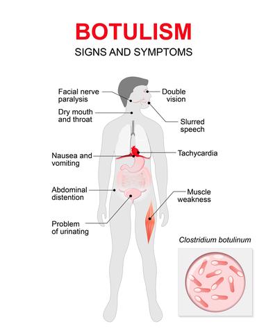 Botulismus-Diagnose und Behandlung: Was Sie wissen müssen Botulismus-Diagnose und Behandlung: Was Sie wissen müssen