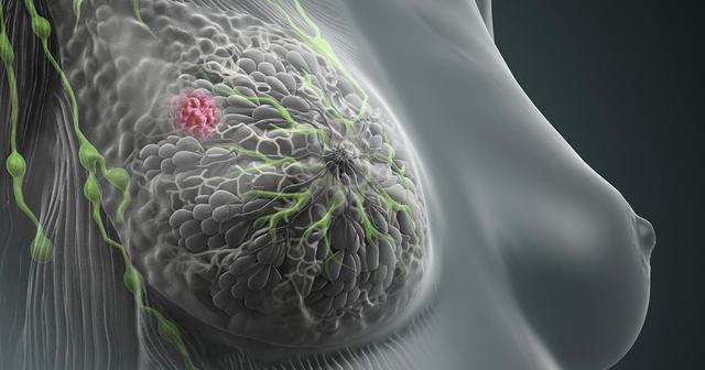 Hautveränderungen und Schmerzen: Typische Symptome von fortgeschrittenem Brustkrebs