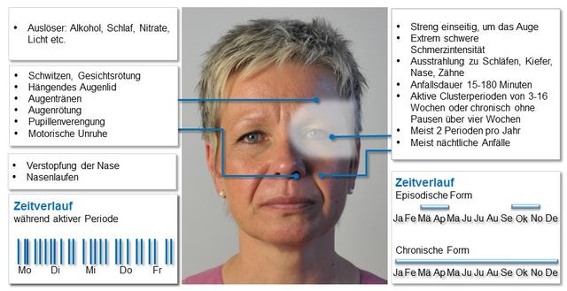 Vorbeugung und Prävention von Cluster-Kopfschmerzen