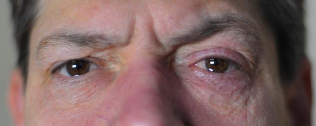 Ursachen und Risikofaktoren für Cluster-Kopfschmerzen