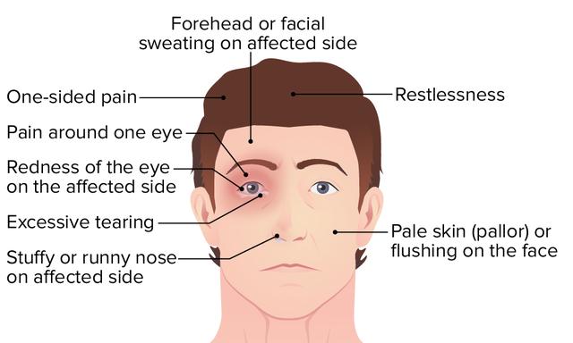 Symptome und Merkmale von Cluster-Kopfschmerzen