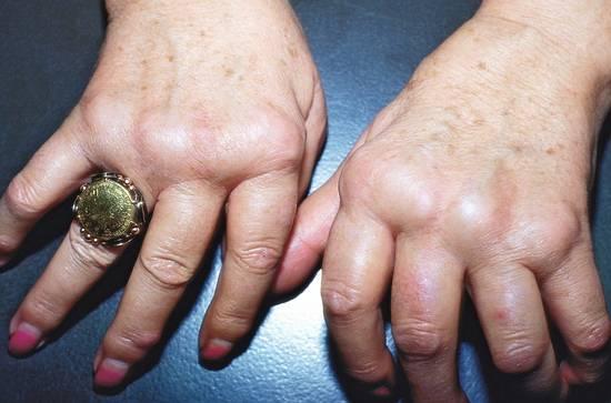 Cortison vs. MTX: Welches Medikament hat mehr Risiken? Cortison vs. MTX: Welches Medikament hat mehr Risiken?