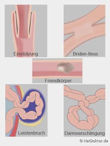 Darmverschluss: Ursachen, Symptome und Behandlungsmöglichkeiten im Überblick