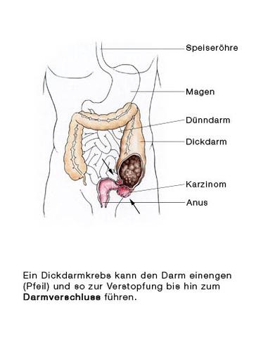 Notfall Darmverschluss: Was Sie wissen sollten und wie Sie reagieren können Notfall Darmverschluss: Was Sie wissen sollten und wie Sie reagieren können