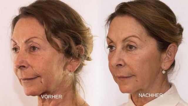 Lang anhaltende Ergebnisse mit Fadenlifting: Was Sie wissen sollten Lang anhaltende Ergebnisse mit Fadenlifting: Was Sie wissen sollten