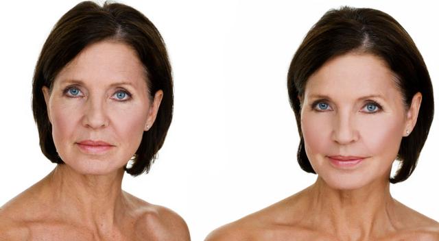 Alles über Fadenlifting: Eine neue Methode für ein jugendliches Gesicht Alles über Fadenlifting: Eine neue Methode für ein jugendliches Gesicht