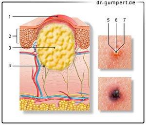 Behandlung von Abszessen: Wann ist der richtige Zeitpunkt für eine Eröffnung?