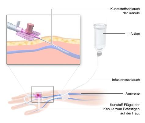 Wie lange wirkt die Chemotherapie nach der Behandlung? Wie lange wirkt die Chemotherapie nach der Behandlung?