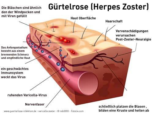Gürtelrose: Wie lange dauert die Erkrankung? Gürtelrose: Wie lange dauert die Erkrankung?