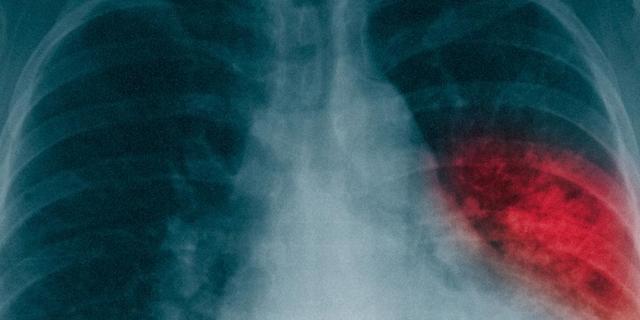 Prognose bei Lungenentzündung: Wie lange dauert es, bis man nach einer Pneumonie wieder fit ist?