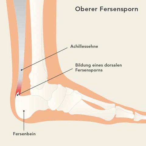 Dauer der Behandlung bei einem Fersensporn: Was sollten Sie wissen?