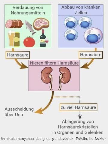 Dauer eines Gichtanfalls: Was ist normal? Dauer eines Gichtanfalls: Was ist normal?
