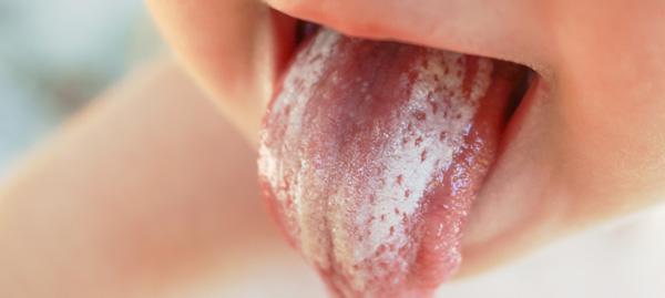 Wie lange sollte man bei Scharlach Bettruhe einhalten?