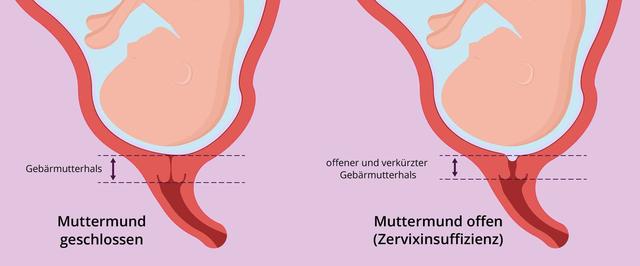 Sind Sie schwanger? So erkennen Sie es am Muttermund Sind Sie schwanger? So erkennen Sie es am Muttermund
