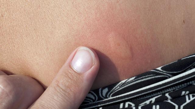 Wespenstiche: Wie oft können sie wirklich zustechen?