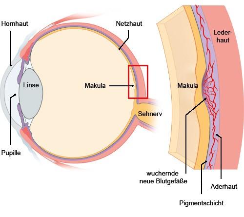 Makuladegeneration: Ursachen und Auswirkungen auf die Netzhaut Makuladegeneration: Ursachen und Auswirkungen auf die Netzhaut