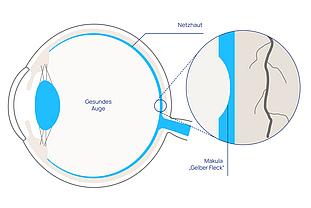 Wie wirkt das Altern auf die Makula? Wie wirkt das Altern auf die Makula?