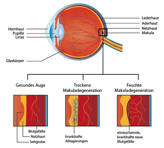 Drusen-Ablagerungen unter der Makula: Frühe Anzeichen einer AMD Drusen-Ablagerungen unter der Makula: Frühe Anzeichen einer AMD